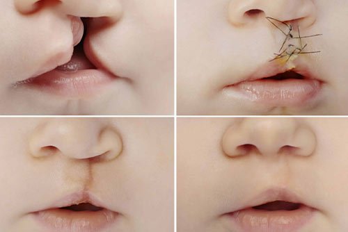cleftlip
